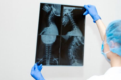 Osteochondrosis spinal diseases