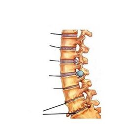 Stages of development of osteochondrosis