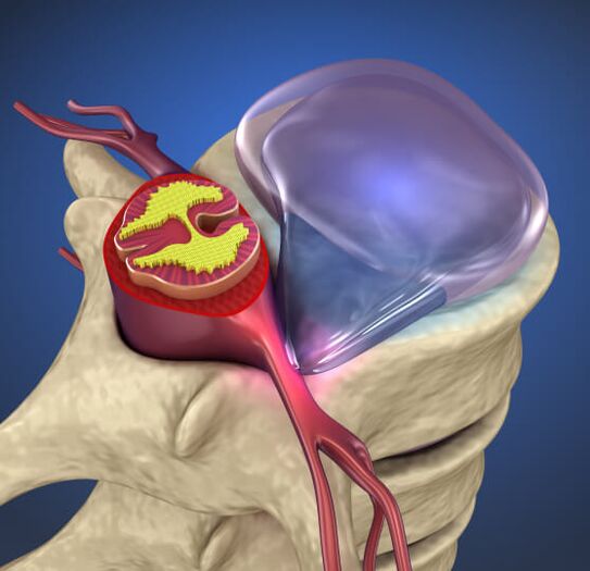 Intermediate hernia