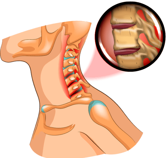 Osteochondrosis in the neck