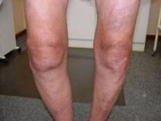 Symptoms of osteoarthritis of the knee joint